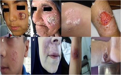 Determinants of Unresponsiveness to Treatment in Cutaneous Leishmaniasis: A Focus on Anthroponotic Form Due to Leishmania tropica